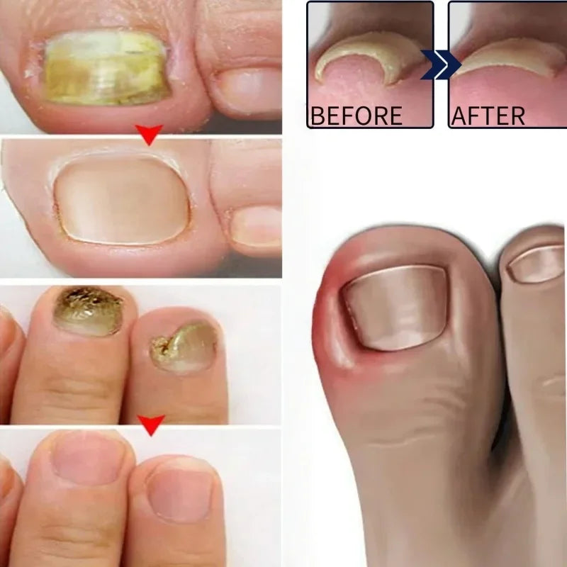 Fungal Nail Repair Drops Infection Nail Removal Anti Paronychia Improve Broken Cracked Discolored Toenail Renewal Care Essence
