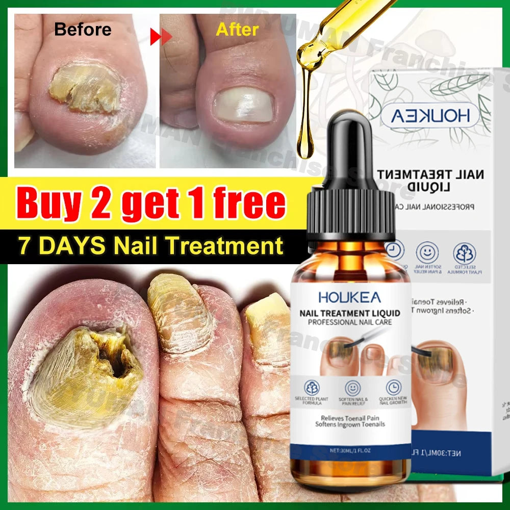 7 Days Nail Fungus Treatment Serum Repair Toe Nails Fungal Removal Essence Anti Infection Paronychia Onychomycosis Health Care