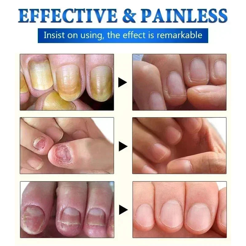 NewFungal Nail Treatment Oil Foot Repair Essence Toe Nail Fungus Removal Gel Anti Infection Cream Fungal Nail Removal Paronychi