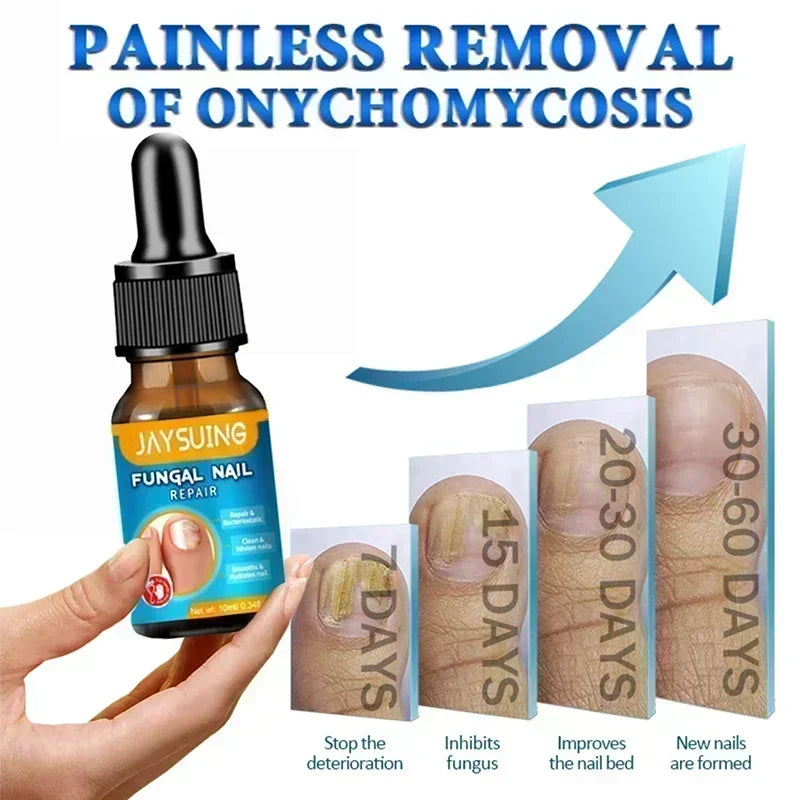 NewFungal Nail Treatment Oil Foot Repair Essence Toe Nail Fungus Removal Gel Anti Infection Cream Fungal Nail Removal Paronychi