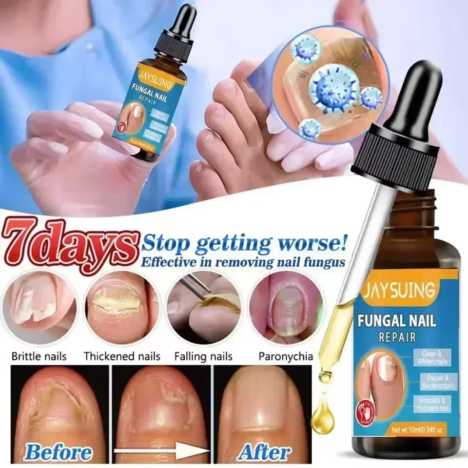 NewFungal Nail Treatment Oil Foot Repair Essence Toe Nail Fungus Removal Gel Anti Infection Cream Fungal Nail Removal Paronychi