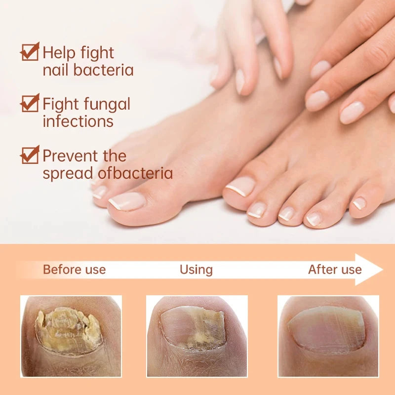 Fungal Nail Treatment Serum Foot Nail Fungus Removal Repair Gel Anti Infection Paronychia Onychomycosis Foot Nails Care Liquid