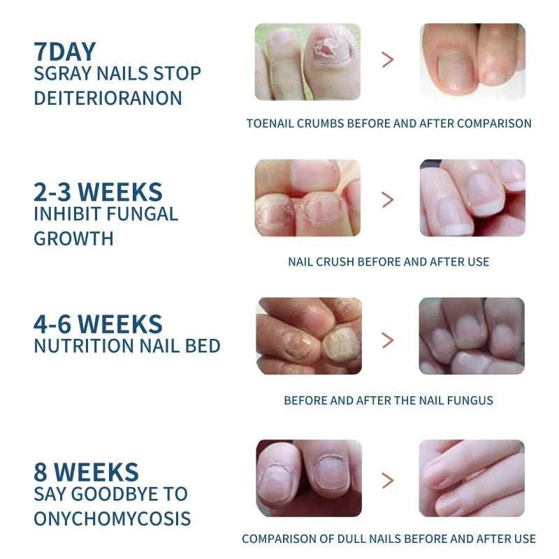 Fungal Nail Repair Drops Infection Nail Removal Anti Paronychia Improve Broken Cracked Discolored Toenail Renewal Care Essence