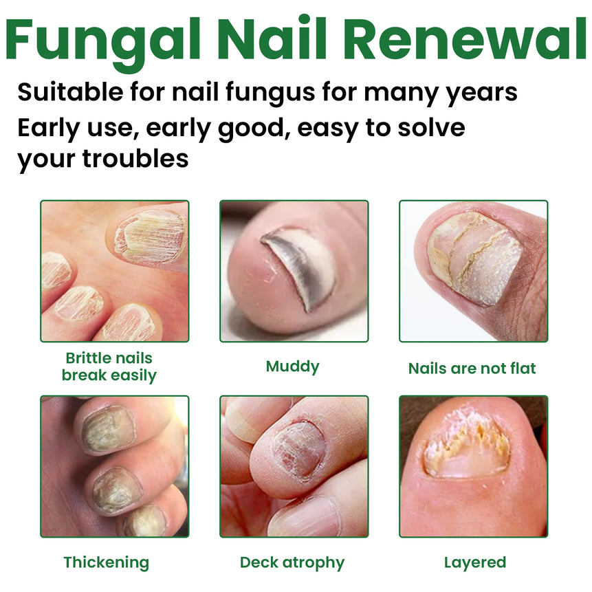 Nail Treatment Solution Repair Damaged Nail Restore Healthy Growth Nourish Cuticles Strengthen Brittle Nail Recovery Care Lotion