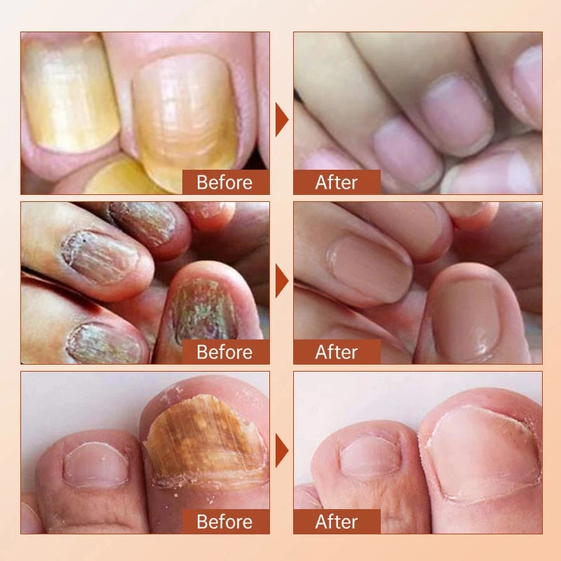 Fungal Nail Treatment Serum Foot Nail Fungus Removal Repair Gel Anti Infection Paronychia Onychomycosis Foot Nails Care Liquid