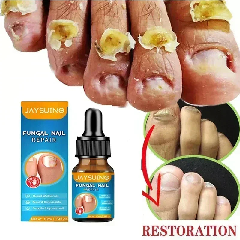 NewFungal Nail Treatment Oil Foot Repair Essence Toe Nail Fungus Removal Gel Anti Infection Cream Fungal Nail Removal Paronychi
