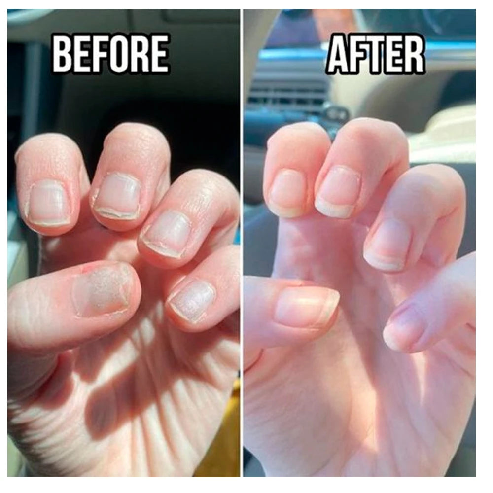 LOVCARRIE Keratin Nail Treatment Growth Formula Protein Normal Nail Strengthener Top Repair Serum Liquid 15ML Healthy Care Toe