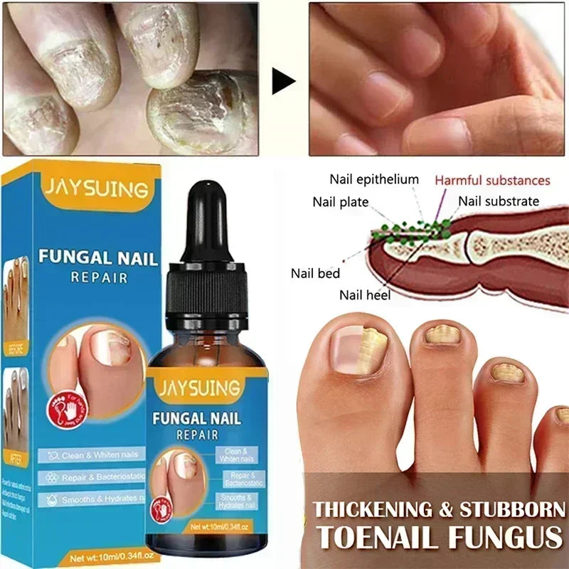 NewFungal Nail Treatment Oil Foot Repair Essence Toe Nail Fungus Removal Gel Anti Infection Cream Fungal Nail Removal Paronychi
