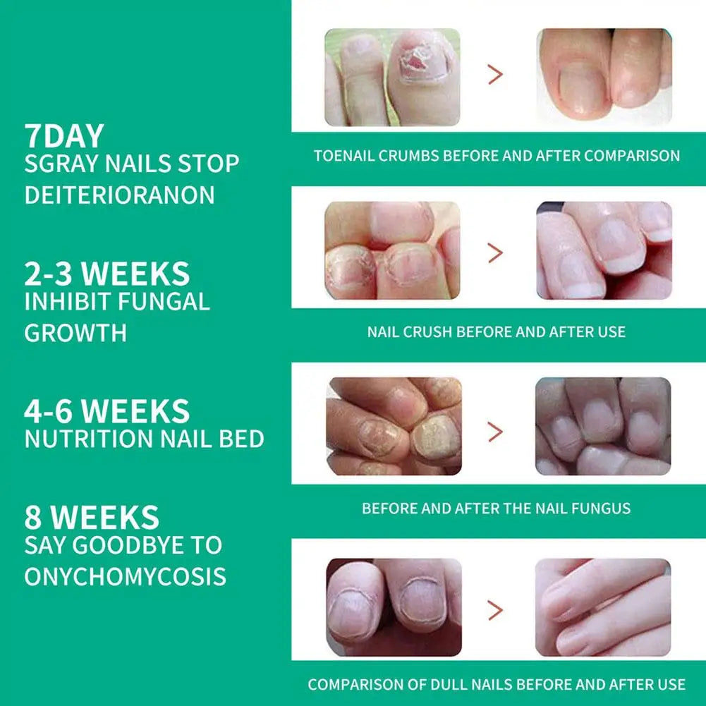 Fungal Nail Repair Serum 10ml Foot Toe Nail Fungus Atreatment Nails Gel Anti Paronychia Onychomycosis Care Essence