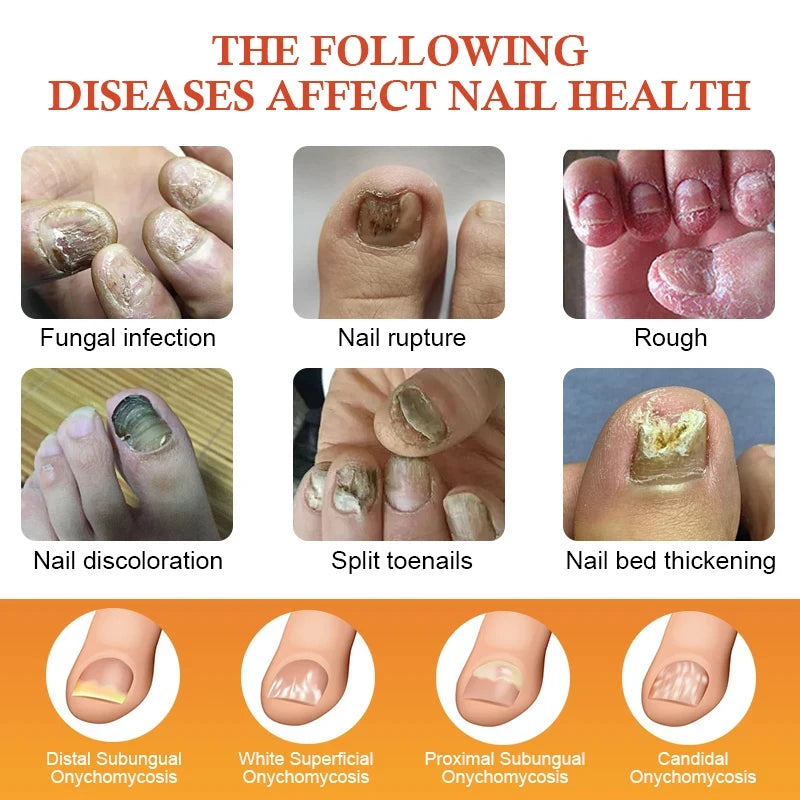 7 Days Nail Fungus Treatment Serum Repair Toe Nails Fungal Removal Essence Anti Infection Paronychia Onychomycosis Health Care