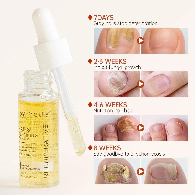 Fungal Nail Treatment Serum Foot Nail Fungus Removal Repair Gel Anti Infection Paronychia Onychomycosis Foot Nails Care Liquid