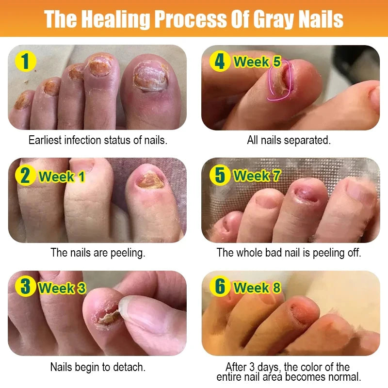 7 Days Nail Fungus Treatment Serum Repair Toe Nails Fungal Removal Essence Anti Infection Paronychia Onychomycosis Health Care