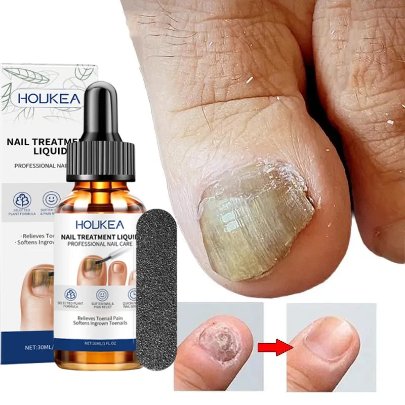 7 Days Nail Fungus Treatment Serum Repair Toe Nails Fungal Removal Essence Anti Infection Paronychia Onychomycosis Health Care