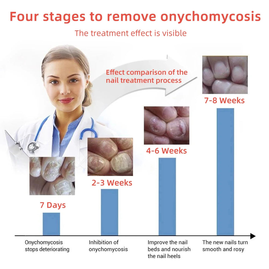 Fungal Nail Treatment Serum Foot Nail Fungus Removal Repair Gel Anti Infection Paronychia Onychomycosis Foot Nails Care Liquid