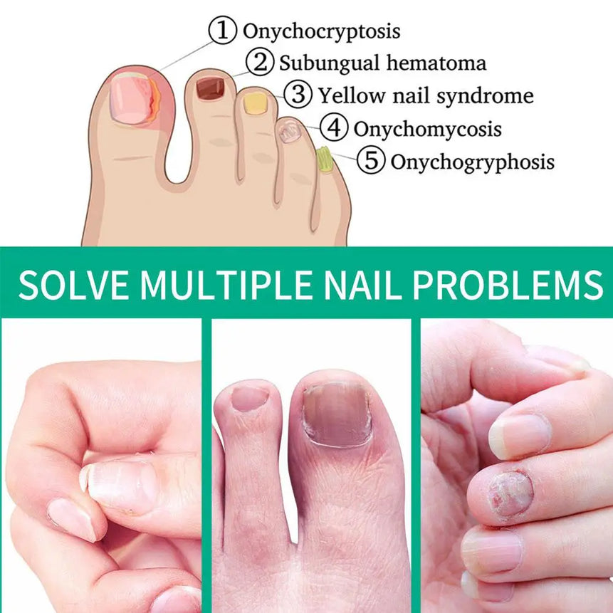 Fungal Nail Repair Serum 10ml Foot Toe Nail Fungus Atreatment Nails Gel Anti Paronychia Onychomycosis Care Essence