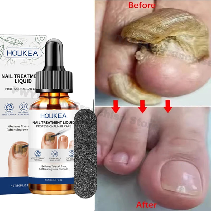 7 Days Nail Fungus Treatment Serum Repair Toe Nails Fungal Removal Essence Anti Infection Paronychia Onychomycosis Health Care